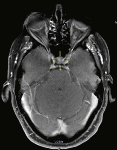Scan displays mild prominence and heterogenicity of the pituitary gland, diagnosed as nonfunctional pituitary adenoma