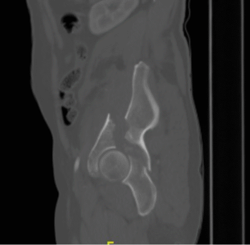 B) Sagittal View