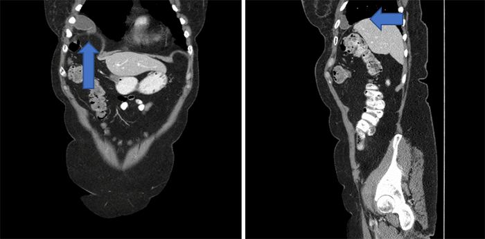 A) Coronal view showing the gallbladder above the diaphragm, and B) sagittal view showing the gallbladder above the diaphragm