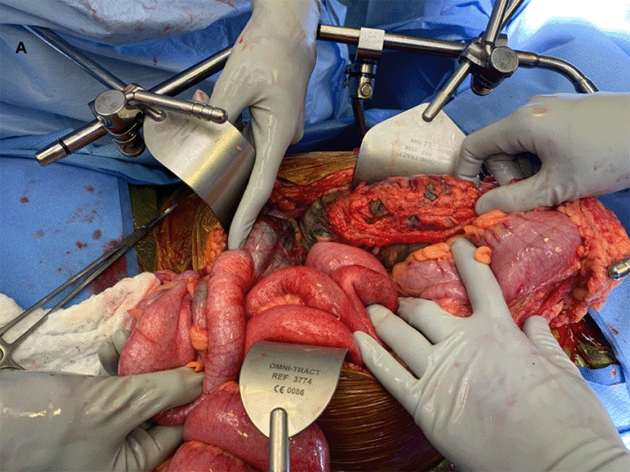 (A) Dark, necrotic bowel is surrounded by hyperemic colon