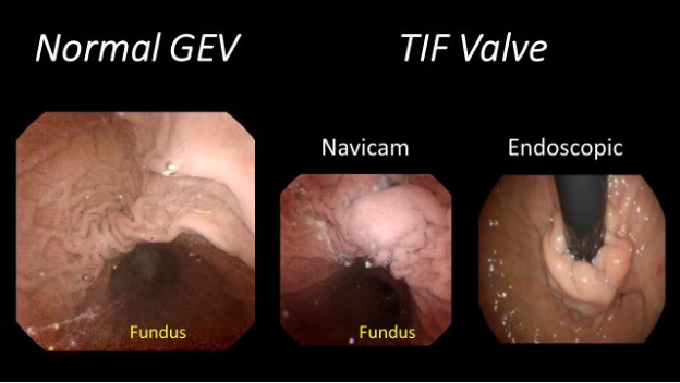 Advanced capsule endoscopy technology provides high-resolution views of a normal gastroesophageal valve (GEV) and transoral incisionless fundoplication valve, as compared to the endoscopic view.