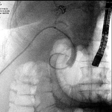 Figure 6. A PTBD tube was advanced across the biloma and into the cystic duct down into the duodenum by the IR team. 