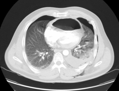 B) Axial View