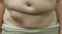 Figure 1. Bulge identified in right lower quadrant when standing upright (8/13/2015)