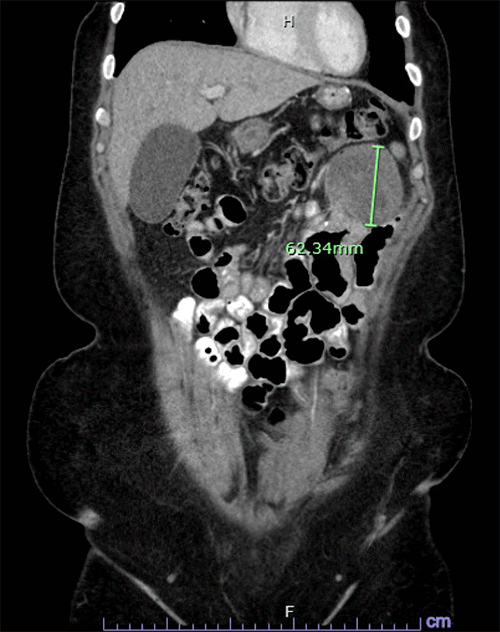 B) coronal view