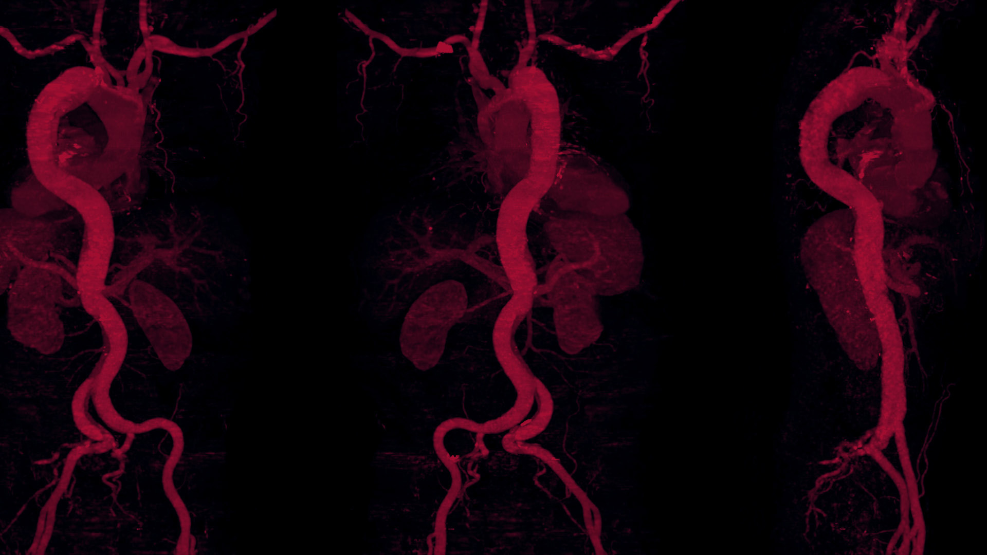 Smart Solutions  Are Transforming Aortic Dissection Diagnosis and Repair