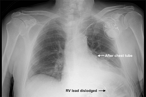 Right ventricular (RV) pacemaker lead has changed position compared to immediate postoperative CXR five days prior.