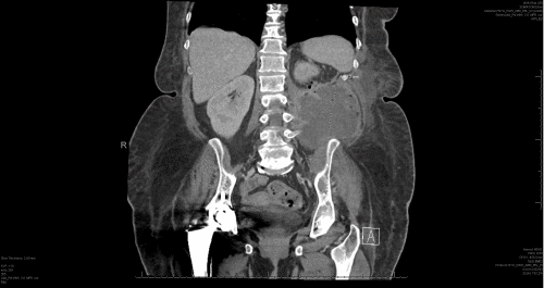 A) Coronal view showing loculated fluid collection/abscess containing air bubbles and air-fluid level in the left retroperitoneum, measuring 10.0 × 9.5 × 9.8 cm, extending along the left psoas muscle and beyond the abdominal musculature into the soft tissues of the left flank